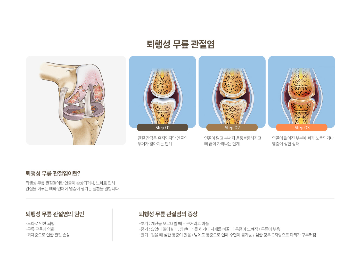 퇴행성 무릎 관절염